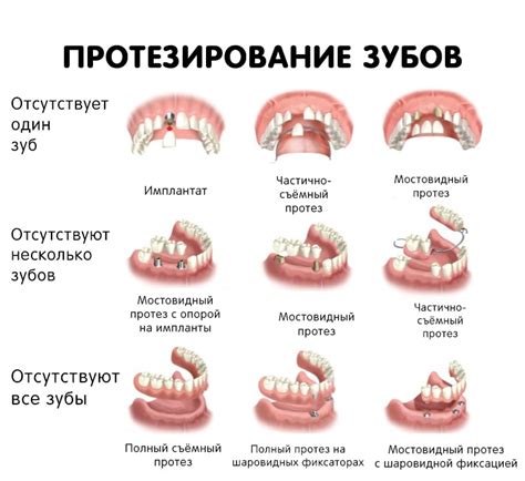 Виды протезов